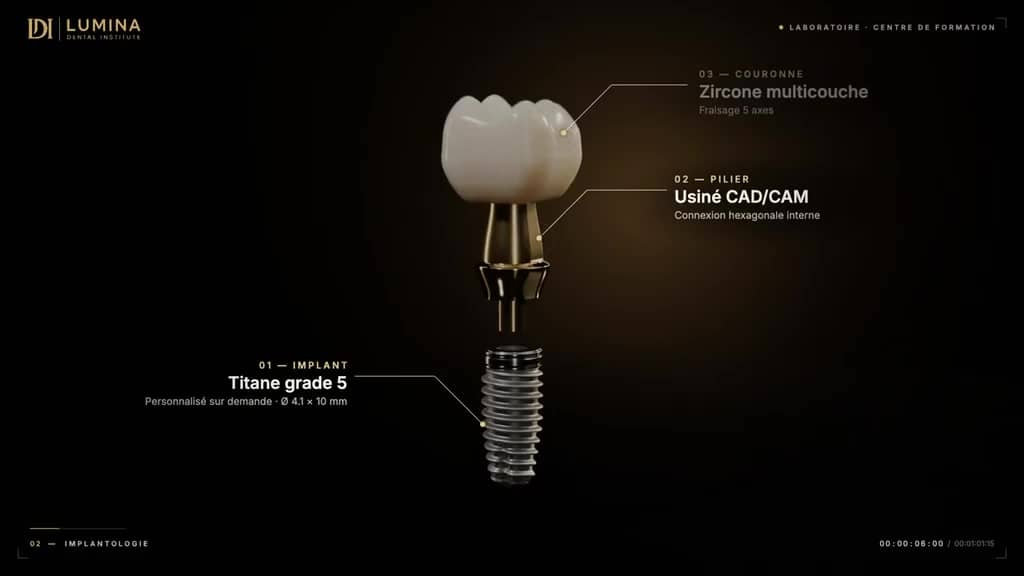 Implant, pilier et couronne